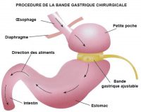 Anneau Gastrique virtuel